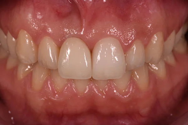 Zähne eines Ober- und Unterkiefers